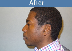 Milwaukee Plastic Surgery - Chin Implant - 2-6