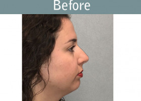 Milwaukee Plastic Surgery - Chin Implant - 3-1