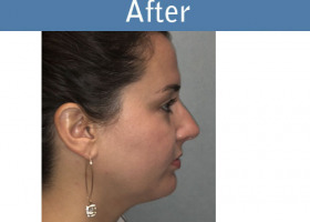 Milwaukee Plastic Surgery - Chin Implant - 3-2