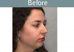 Milwaukee Plastic Surgery - Chin Implant - 3-3