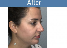 Milwaukee Plastic Surgery - Chin Implant - 3-4