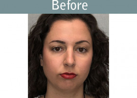 Milwaukee Plastic Surgery - Chin Implant - 3-5