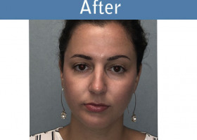 Milwaukee Plastic Surgery - Chin Implant - 3-6
