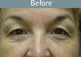 Milwaukee Plastic Surgery - Eye Lift - 1-1