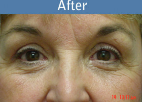 Milwaukee Plastic Surgery - Eye Lift - 1-2