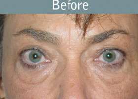 Milwaukee Plastic Surgery - Eye Lift - 2-1