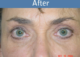 Milwaukee Plastic Surgery - Eye Lift - 2-2