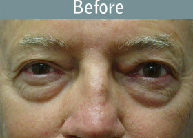 Milwaukee Plastic Surgery - Eye Lift - 3-1