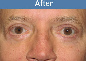 Milwaukee Plastic Surgery - Eye Lift - 3-2