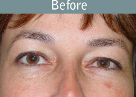 Milwaukee Plastic Surgery - Eye Lift - 4-1