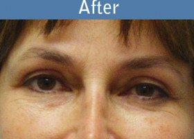 Milwaukee Plastic Surgery - Eye Lift - 4-2