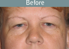 Milwaukee Plastic Surgery - Eye Lift - 5-1