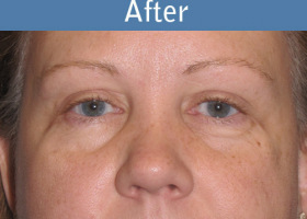 Milwaukee Plastic Surgery - Eye Lift - 5-2