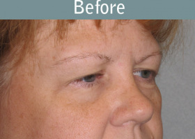 Milwaukee Plastic Surgery - Eye Lift - 6-1