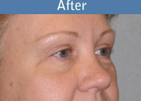 Milwaukee Plastic Surgery - Eye Lift - 6-2