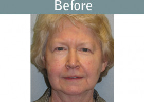 Milwaukee Plastic Surgery - Face Lift - 1-1