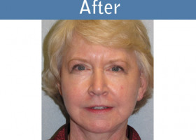 Milwaukee Plastic Surgery - Face Lift - 1-2