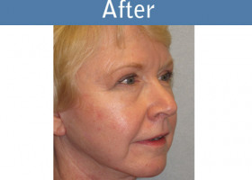 Milwaukee Plastic Surgery - Face Lift - 1-4