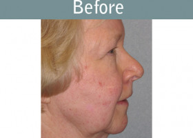 Milwaukee Plastic Surgery - Face Lift - 1-5