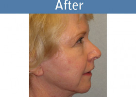 Milwaukee Plastic Surgery - Face Lift - 1-6