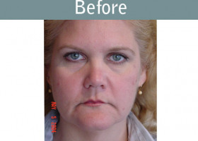 Milwaukee Plastic Surgery - Face Lift - 3-1