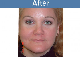 Milwaukee Plastic Surgery - Face Lift - 3-2
