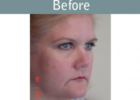 Milwaukee Plastic Surgery - Face Lift - 3-3