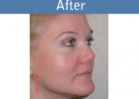 Milwaukee Plastic Surgery - Face Lift - 3-4
