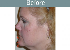 Milwaukee Plastic Surgery - Face Lift - 3-5