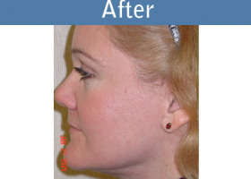 Milwaukee Plastic Surgery - Face Lift - 3-6