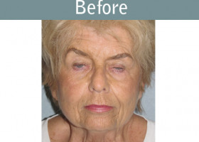 Milwaukee Plastic Surgery - Face Lift - 4-1