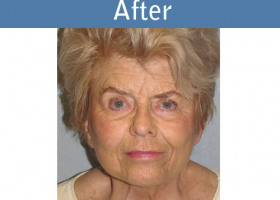 Milwaukee Plastic Surgery - Face Lift - 4-2