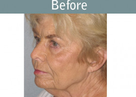 Milwaukee Plastic Surgery - Face Lift - 4-3
