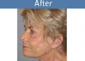 Milwaukee Plastic Surgery - Face Lift - 4-4