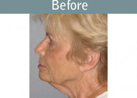 Milwaukee Plastic Surgery - Face Lift - 4-5