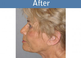 Milwaukee Plastic Surgery - Face Lift - 4-6