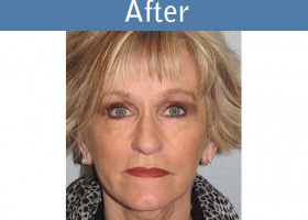 Milwaukee Plastic Surgery - Face Lift - 5-2