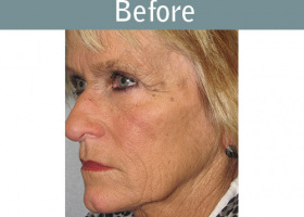 Milwaukee Plastic Surgery - Face Lift - 5-3
