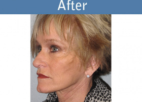 Milwaukee Plastic Surgery - Face Lift - 5-4