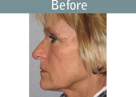 Milwaukee Plastic Surgery - Face Lift - 5-5