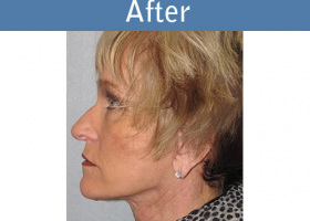 Milwaukee Plastic Surgery - Face Lift - 5-6