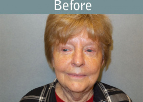 Milwaukee Plastic Surgery - Face Lift - 6-1