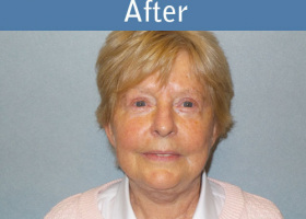 Milwaukee Plastic Surgery - Face Lift - 6-2