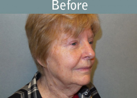 Milwaukee Plastic Surgery - Face Lift - 6-3
