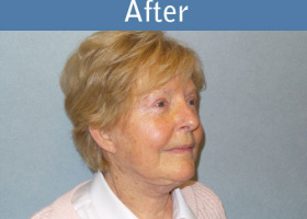 Milwaukee Plastic Surgery - Face Lift - 6-4