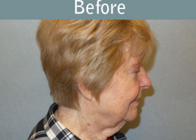 Milwaukee Plastic Surgery - Face Lift - 6-5