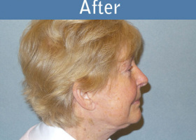 Milwaukee Plastic Surgery - Face Lift - 6-6