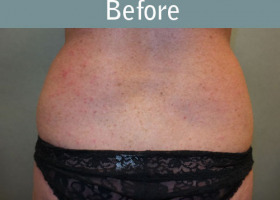 Milwaukee Plastic Surgery - Liposuction - 10-1