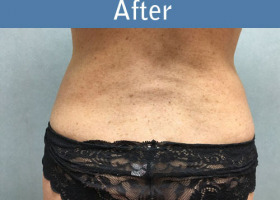 Milwaukee Plastic Surgery - Liposuction - 10-2