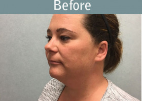 Milwaukee Plastic Surgery - Liposuction - 11-1